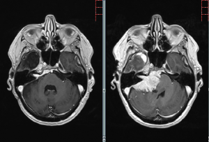 Hirntumor Gliom Glioblastom Meningeom Prof Dr Med J Rgen Kiwit